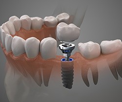 digital diagram of getting a dental implant