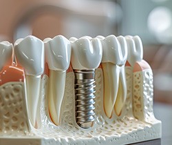 model of integrated dental implant