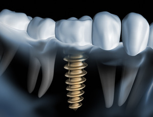 3D render of a dental implant