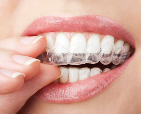 You won't believe this UV light hack 🤯 #dentist #braces #teeth